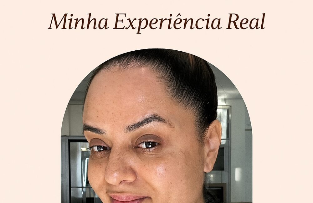 microagulhamento para pele sensível - resultados