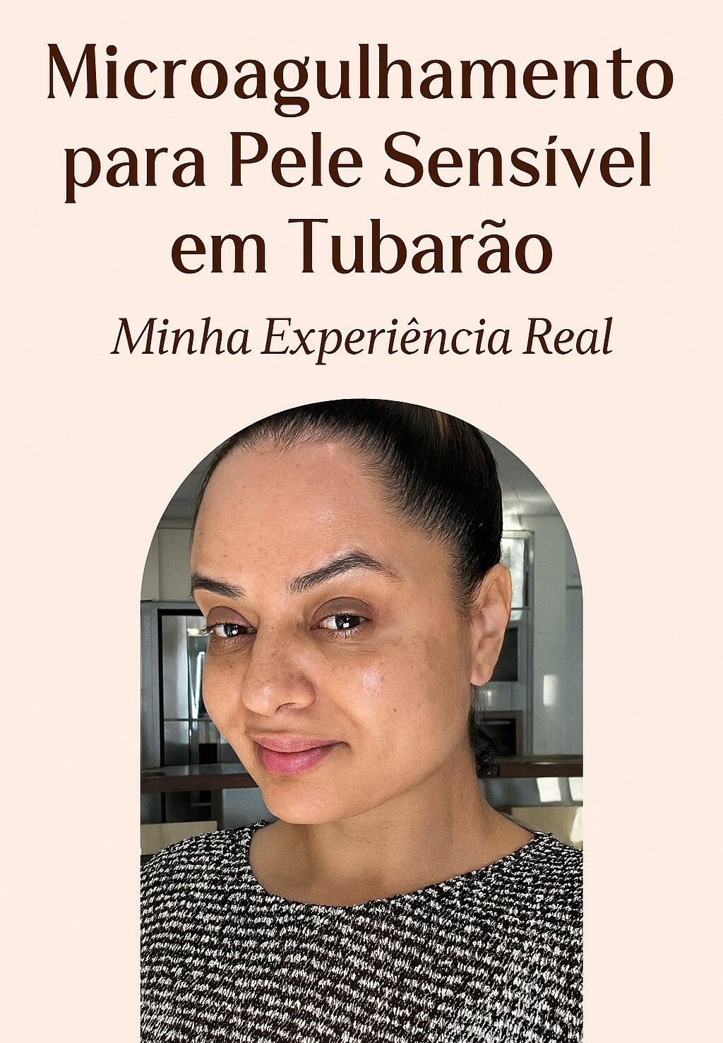 microagulhamento para pele sensível - resultados microagulhamento para pele sensível - resultados