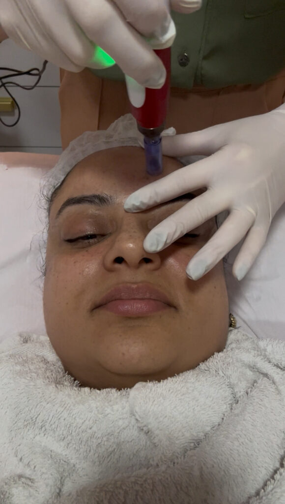 microagulhamento para pele sensível 